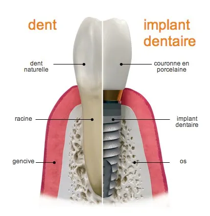 Schéma comparatif d'un implant dentaire et d'une dent naturelle saine