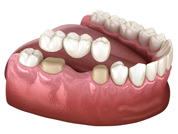 Couronnes céramiques et inlays usinés par CFAO CEREC en une seule séance